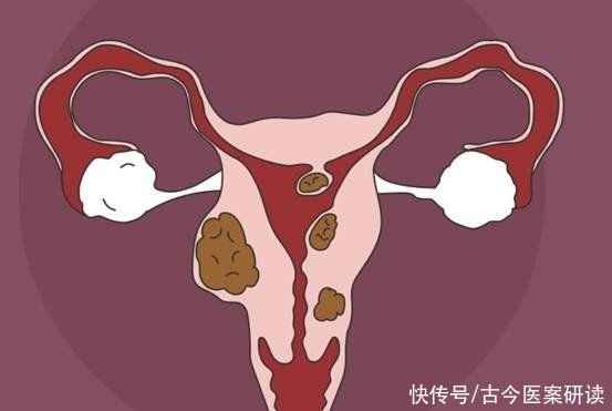 性生活|查出子宫肌瘤,5个习惯建议改掉,容易让子宫肌瘤加重