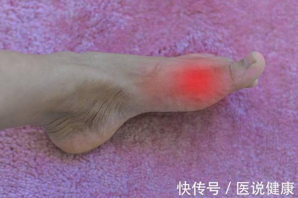 尿毒症|医生:这6种疾病不能拖,或发展为尿毒症,需引起重视