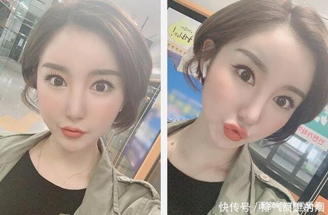 韩国妹子做眼鼻和脂肪填充，网友看到恢复照说侧颜秒杀金泰熙！