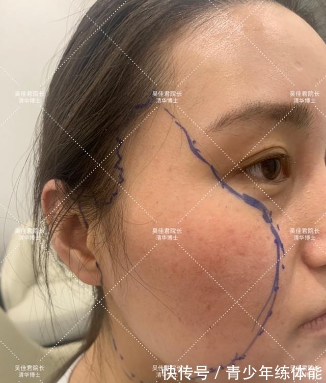 拉皮 小拉皮术后6个月,让她从老阿姨逆袭小姐姐!