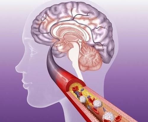 血管痉挛|“腔隙性脑梗塞”虽然症状轻微，但后果严重，4个坏习惯一定要改