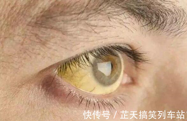 发黄|肝是“哑巴”,如何判断肝好不好?若有这5体征,抽空去趟肿瘤科