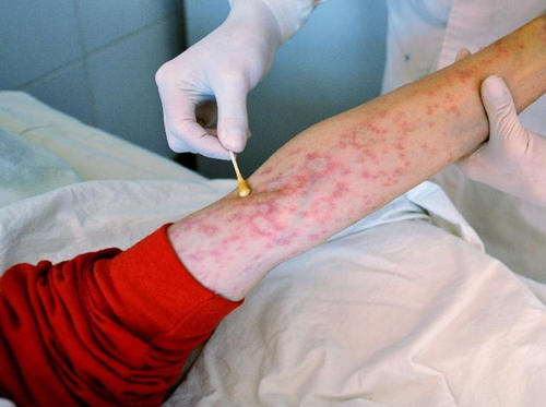 hiv|全国“艾滋”患者125万，不论男女，脖颈处若有这“标志”要注重