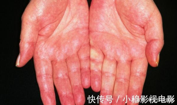 不良习惯|肝病发现即晚期?身体出现这3种异常后,或是肝病前兆,莫忽视