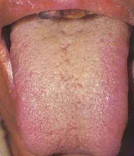 甲状腺疾病|当心！3种舌象，可能提示甲状腺疾病！