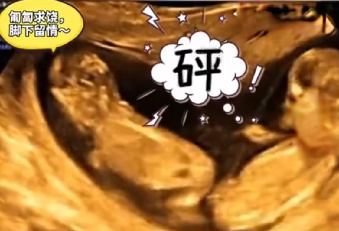肚子|孕妈做四维彩超时突然腹痛,B超显示让人忍俊不禁,网友:挺无辜