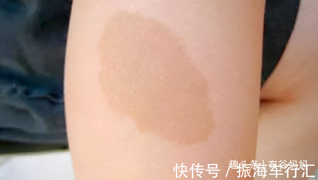 孕期|胎记是怎么来的?产科医生:孕期要避开3种行为,以免宝宝长胎记