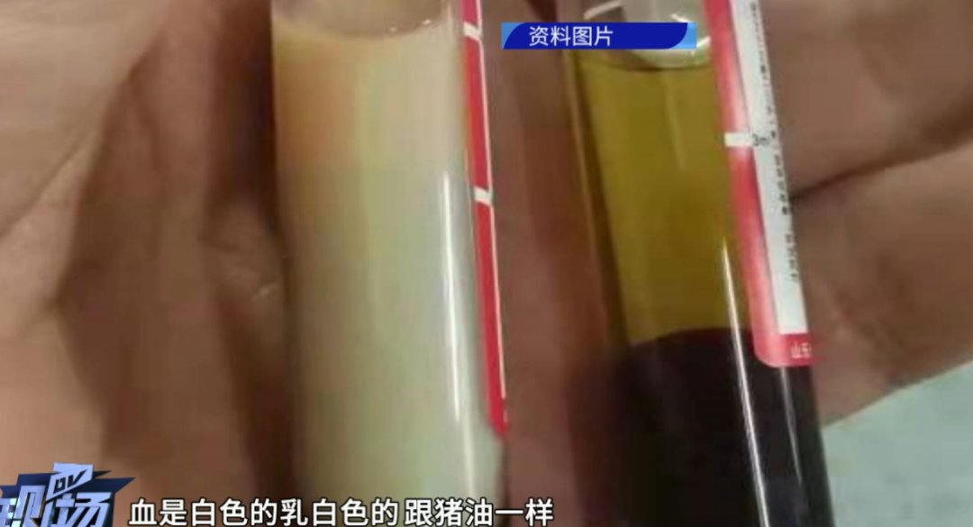 性胰腺炎|可怕！高管跟同事聚餐后竟抽出“牛奶血”