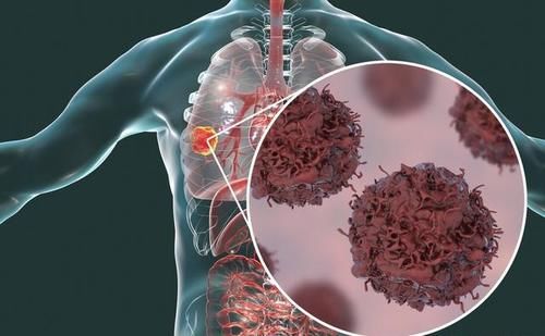 癌症|能不能和癌症患者一起吃饭？这3点一定要事前注意好