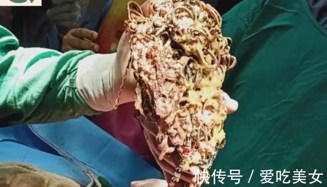 珠宝|印度一女子身体里竟取出价值45万的珠宝:69条链子,80个耳环