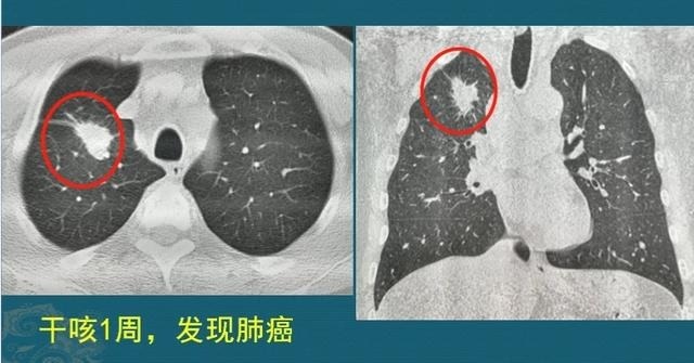 查出来|多数癌症刚查出来能吃能睡,一治疗就变差了,如果不治疗会咋样