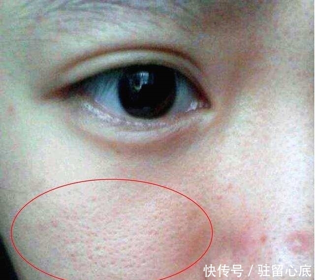 螨虫|几毛钱的它竟然是螨虫的克星,每晚抹一抹,十天让你皮肤细嫩回来