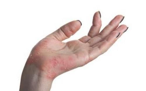 火旺|湿气重易生火，试试这几种除湿茶饮