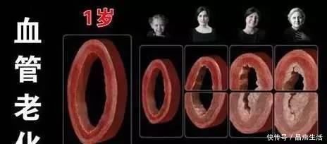 酸痛|血管堵没堵，弯腰摸1个地方就知道，1个小动作，将血栓冲走