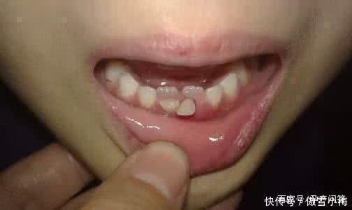 乳牙|6岁女儿长出双排牙能拔吗？医生说出原因后，妈妈：不该这样喂你