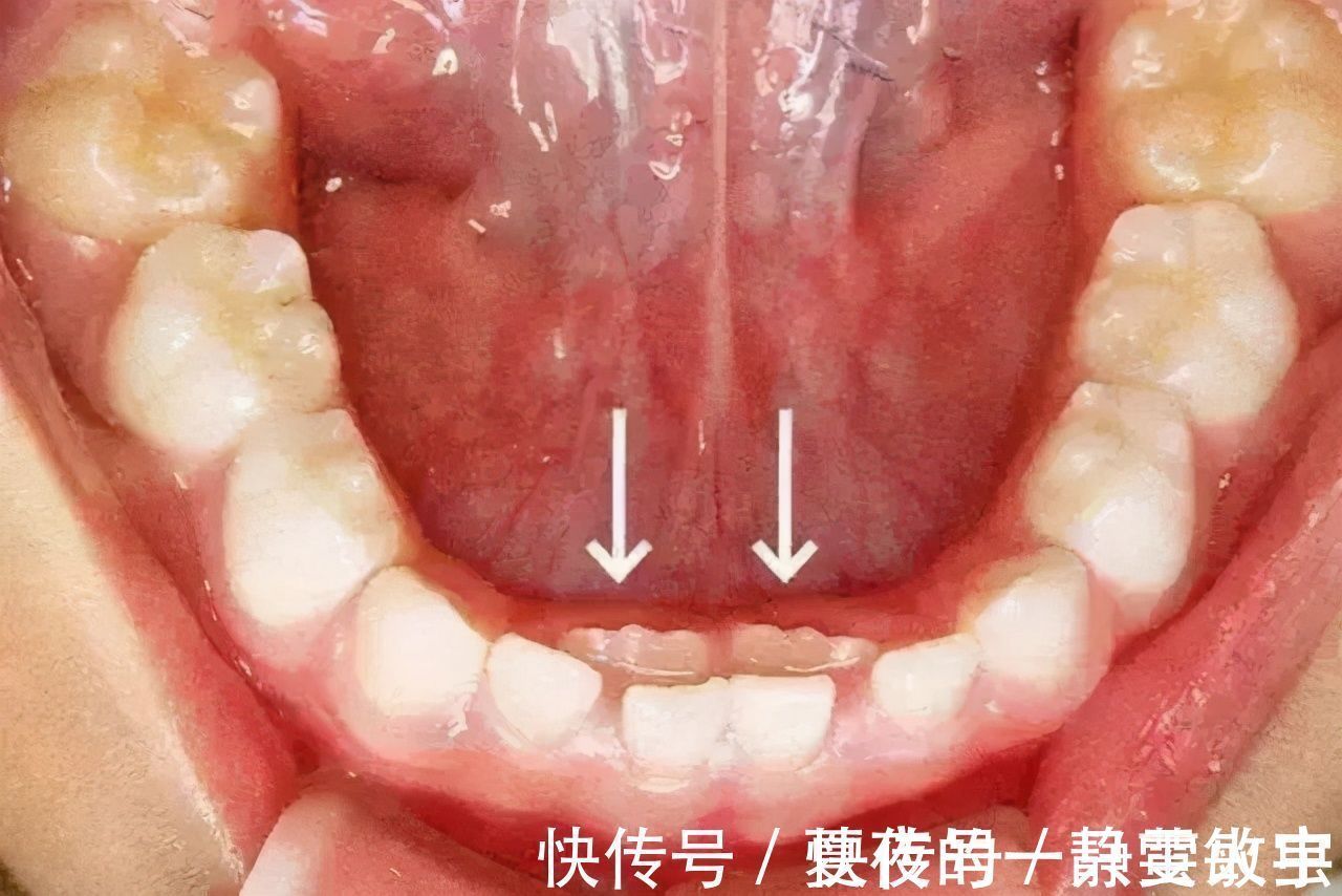 牙齿|孩子长出“双排牙”太难看？是乳牙脱落太晚导致的，需要适当刺激