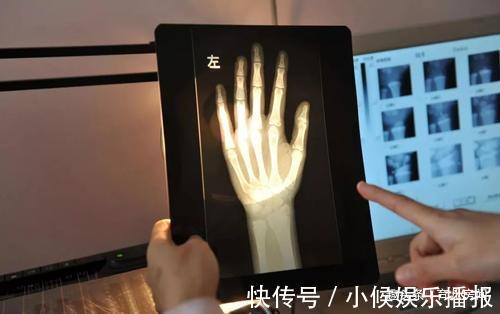 骨骺线|孩子是长得晚,还是真的矮影响身高的3个“关键点”了解一下