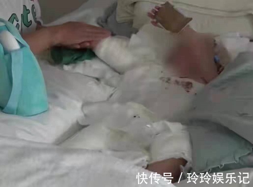 孩子|2岁孩子掉进滚烫开水里致全身50%烧伤，全因奶奶急救方法不对