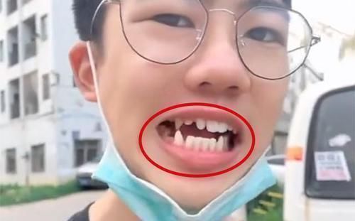 尖牙|15岁男孩长出“尖牙”,妈妈亲手摸过后吐槽:养了个“吸血鬼”