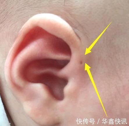 医院|儿子的耳朵上有个小洞宝妈试图挤压,导致孩子昏迷,被送到医院