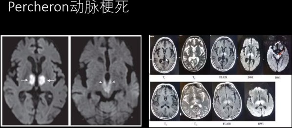 大脑血管疾病|5大脑血管疾病的MRI表现，一文总结