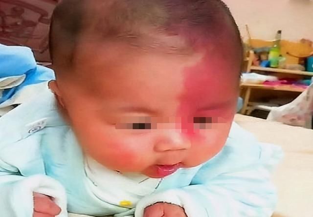 垃圾食品|胎记是如何形成的？产科大夫：除了遗传，和孕妈3种不良行为有关