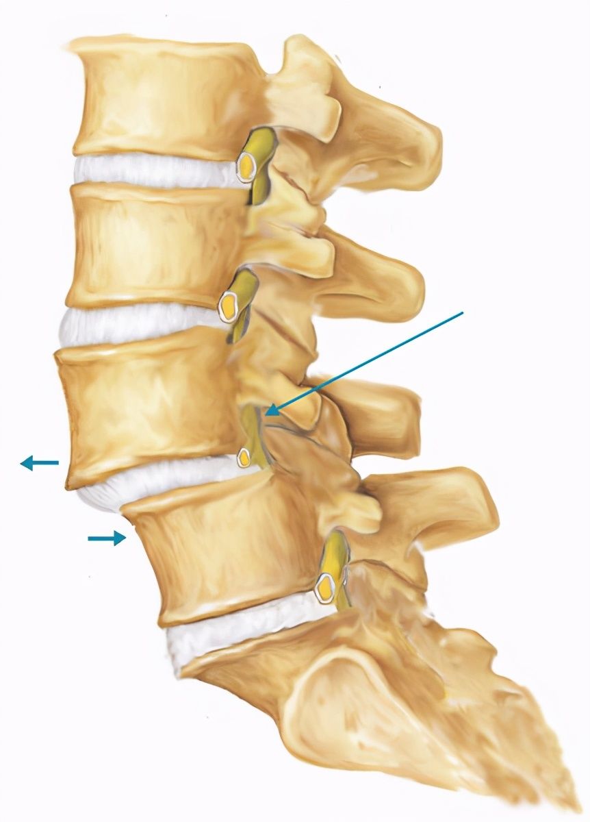 手术治疗|路医生说丨“腰椎滑脱”，究竟是个什么鬼，是腰椎脱位了么？