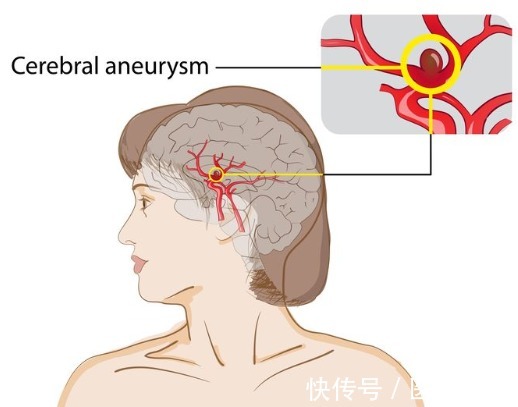 头痛|3个症状突然找上自己，当心是脑血管痉挛的征兆，劝你趁早检查