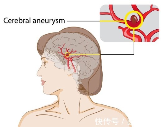 头痛|3个症状突然找上自己,当心是脑血管痉挛的征兆,劝你趁早检查