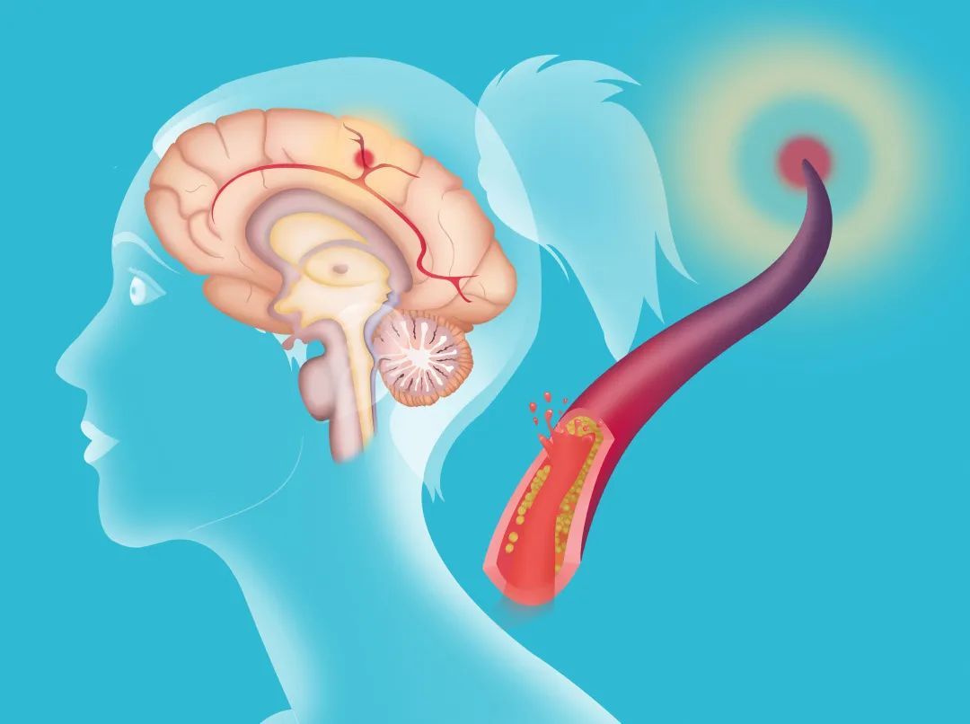 三板斧|这4种表现，十有八九是脑梗在“求救”，尽早去医院