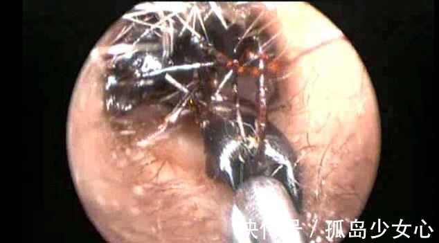 女孩|女孩耳朵疼,医生往女孩耳朵边放糖,结果出来了让人害怕的东西