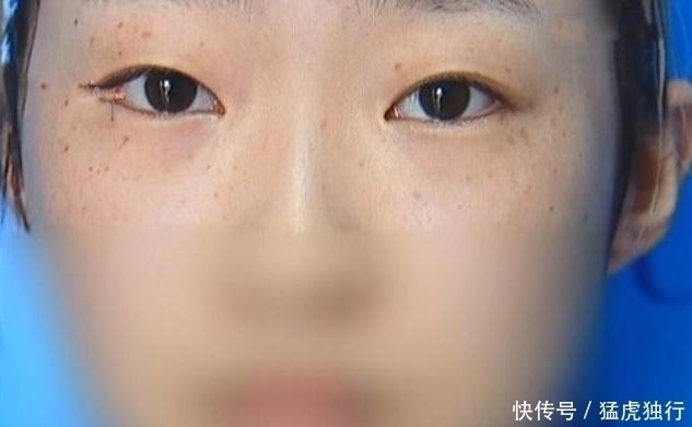双眼皮|女子双眼皮术后眼睑外翻,要求医院赔偿被拒,网友:屠龙刀割的吧