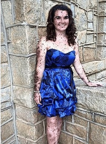 胎记|17岁姑娘满身胎记,从小被人嘲笑,妈妈这是上帝留下的吻痕