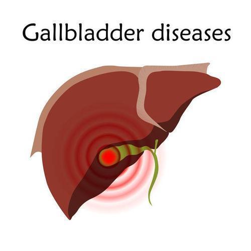ct|胆管癌是什么病,为何发现后是晚期?提前做好3项检查