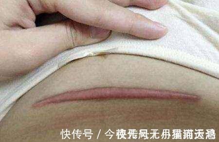 伤口|越来越多的孕妇选择做剖腹产,那你知道剖腹产对身体的伤害吗