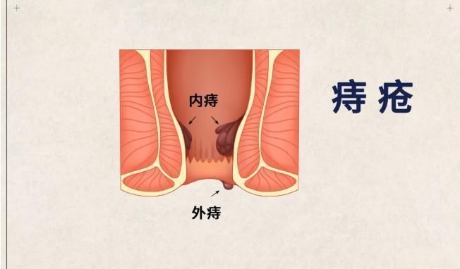 混合痔|痔疮难以根治,但有“死敌”!做好6件事,告别痛痒、肿大和出血