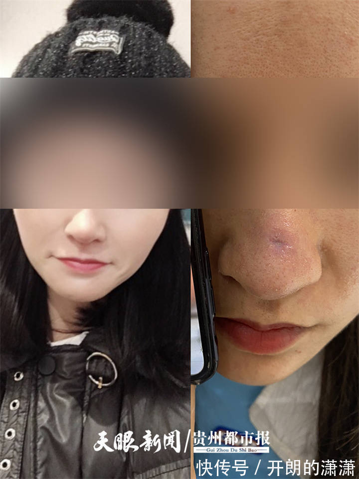 医院 女主播花3.7万元整形 手术后鼻子上却留下一道疤