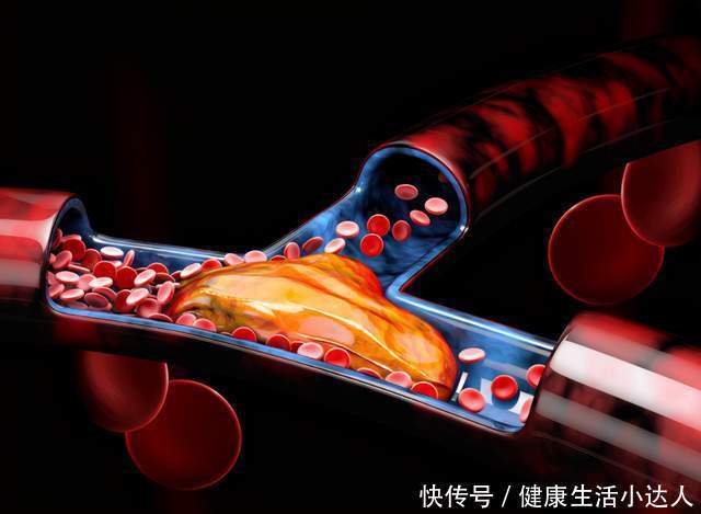 4种东西,“激活”血栓,不想心梗、脑梗找上门,尽量少碰