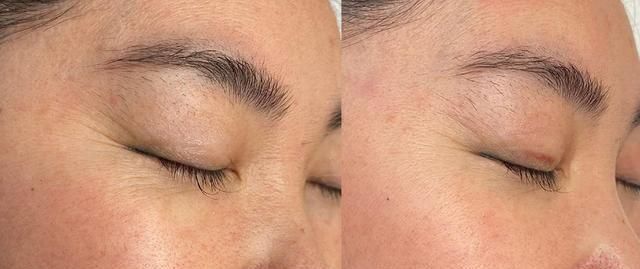 你是“真性皱纹”or“假性皱纹”？从这3点就知道，后者还能拯救