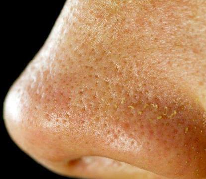 鼻子上挤出的,白色固状是什么?是螨虫分泌物吗?别挤小心败血症