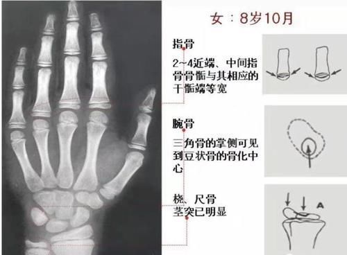 骨骺线|孩子身高是否达标?来对照!孩子的另一个“年龄”,你注意到了吗?