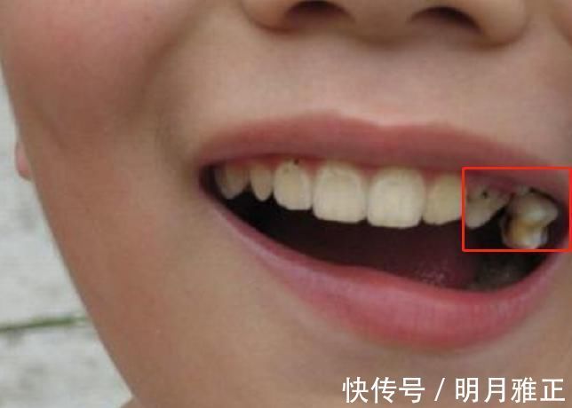 智齿|6岁男娃长“双层牙”，老人的“坏习惯”害了娃，你家有这习惯吗
