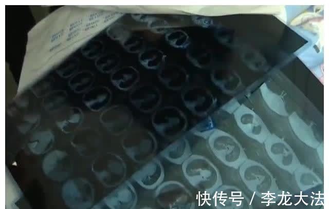 发烧|3岁小孩20天高烧不退,家属发现医院体温计有问题,直接气炸了