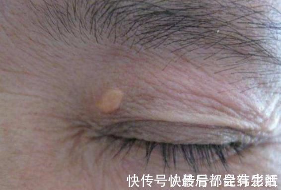 高血脂|血脂高的人,头上会有5种“怪状”,学会3招,不怕脑梗找上门