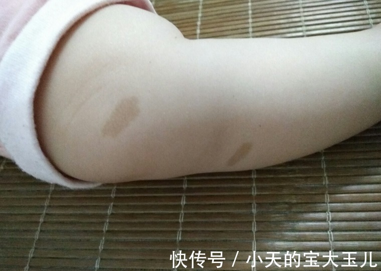 化妆品|婴儿身上为什么会有胎记？资深医生说出原因，与“孕期行为”有关
