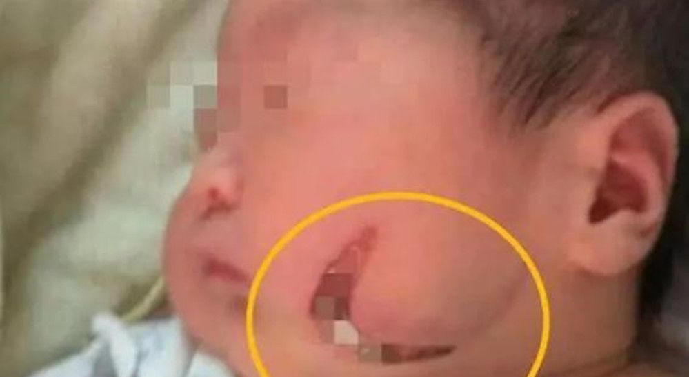 孩子|孩子1岁脸上“产钳印”不消,找医生被反驳,宝妈无言以对