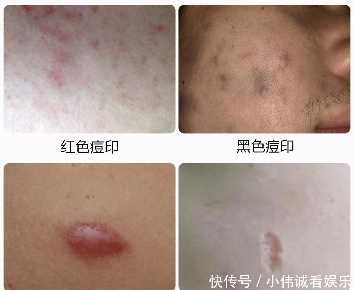 防晒|脸上残留“红色痘印”，你却还在疯狂“美白”？怪不得消不下去