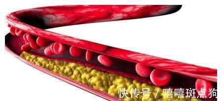 心脑血管|体检发现高血脂,如何快速降血脂?专家:警惕这些降脂误区