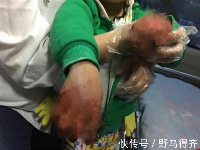 小女孩|小女孩双手伸进油锅,奶奶教科书式处理保住孩子双手,医生都称赞