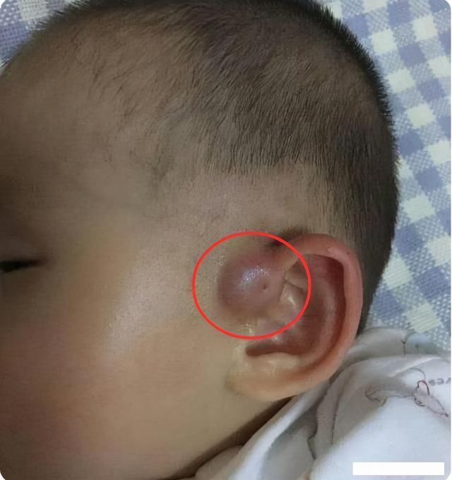 文文|为什么有些孩子耳朵会有“小孔”医生一般不说，父母心里要有数
